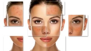 Salicylic peeling: mga tampok at mga patakaran ng application