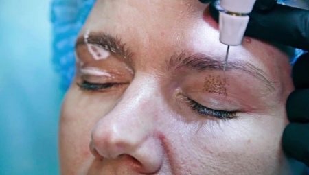 Plasma blepharoplasty: ano ito?
