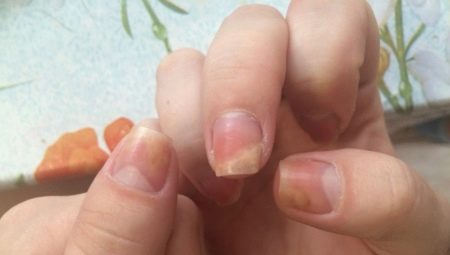 Onycholysis pagkatapos mag-apply ng gel polish
