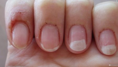 Allergy sa gel polish: mga sanhi, sintomas at pamamaraan ng paggamot