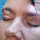 Plasma blepharoplasty: ano ito?