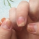 Onycholysis pagkatapos mag-apply ng gel polish